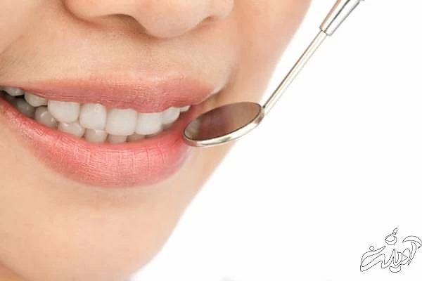 پرکردن فاصله بین دندانها انواع لمینت